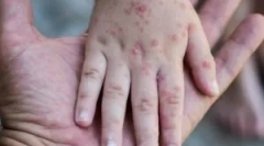 Scabies: патоген, симптоми и лечение